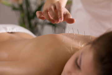 The doctor sticks needles into the girl's body on the acupuncture - obrazy, fototapety, plakaty