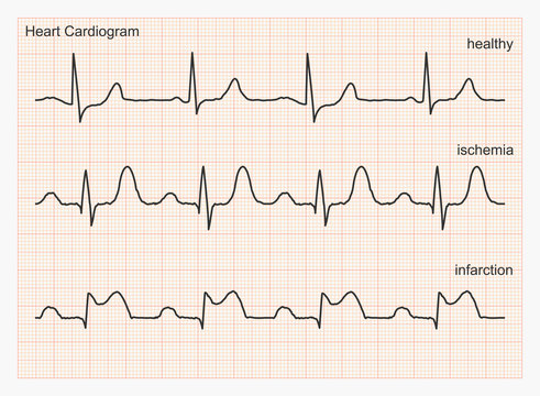 Three types of cardiograms: healthy heart rhythm, ischemia, infarction. Graph paper with ECG graphic line. Vector illustration.