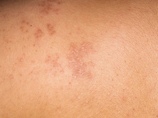 Fototapeta premium Herpes zoster