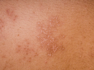 Herpes zoster