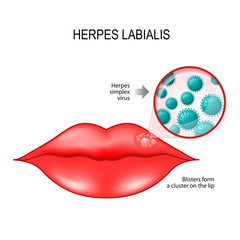 Herpes labialis on the lips