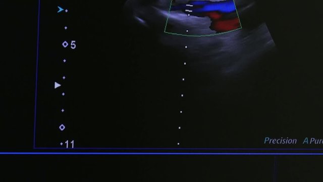 Image of woman uterus on monitor ultrasound examination equipment. Diagnosis of a person in the clinic.