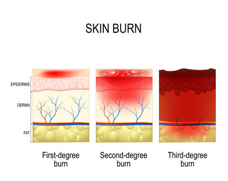 skin burn. Three degrees of burns.