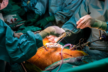 Heart surgery