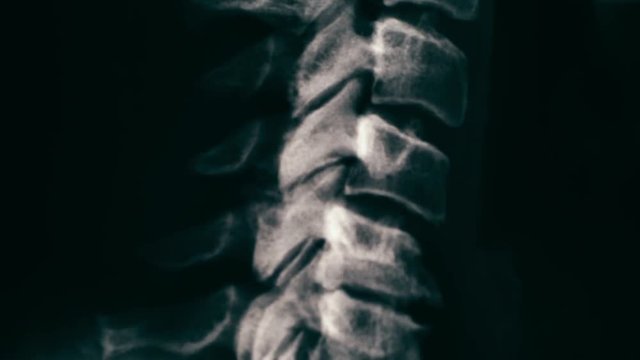 Neck spine MRI Scan or X-Ray video toned. Vertical mouvment of shot from up to down
