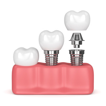 3d render of dental implants in gums