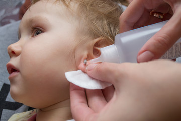 a little girl is treated with a wound on the earlobe after earring piercing