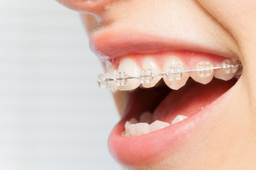 Orthodontics correction of jaws with clear bracket - obrazy, fototapety, plakaty