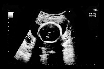 Ultrasound of baby in mother's womb.