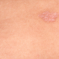 Fototapeta premium Psoriasis skin.