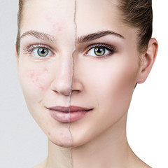 Compare of old photo with acne and healthy skin. - 183482550