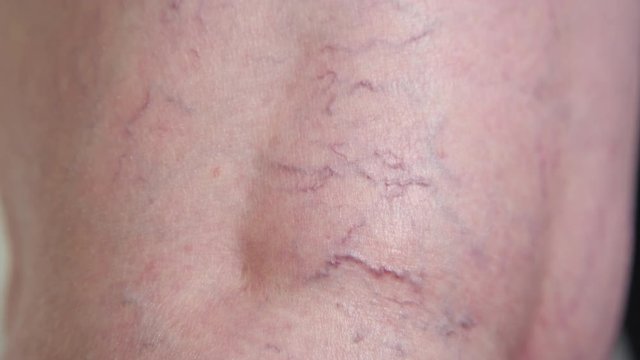 SLOW MOTION CLOSE UP: Unknown lady's curved red varicose veins running down the back of her leg. Examination of elderly woman's problematic leg blood vessels at the doctor's office before procedure.