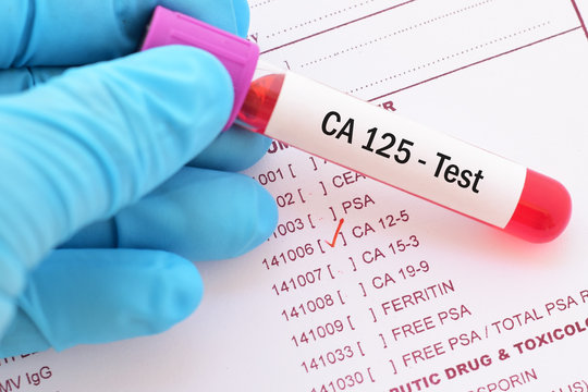 Blood sample with requisition form for CA 125 test, tumor marker for ovarian cancer
