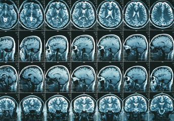MRI brain scan or magnetic resonance of head image results