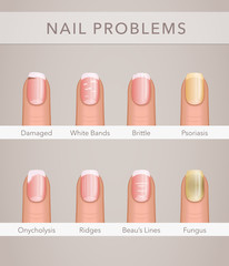 nail problems and illness, vector poster - 183582773