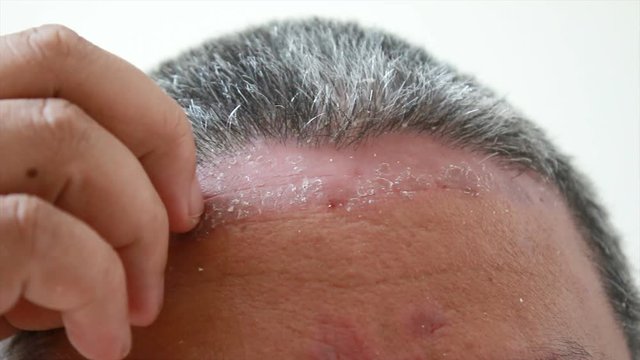 4K Close up shot hands of man scratching skin rash Dermatitis psoriasis patient itchy scratch wound
