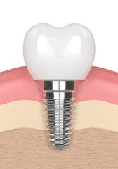 3d render of dental implant in gums