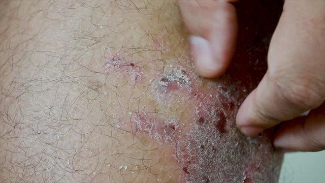4K Close up shot hands of man scratching skin rash Dermatitis psoriasis patient itchy scratch wound