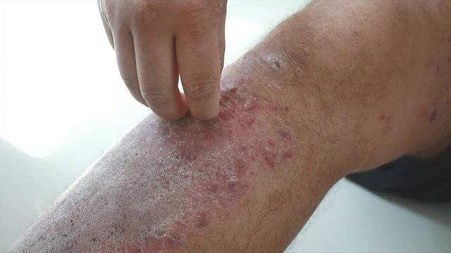 4K Close up shot hands of man scratching skin rash Dermatitis psoriasis patient itchy scratch wound