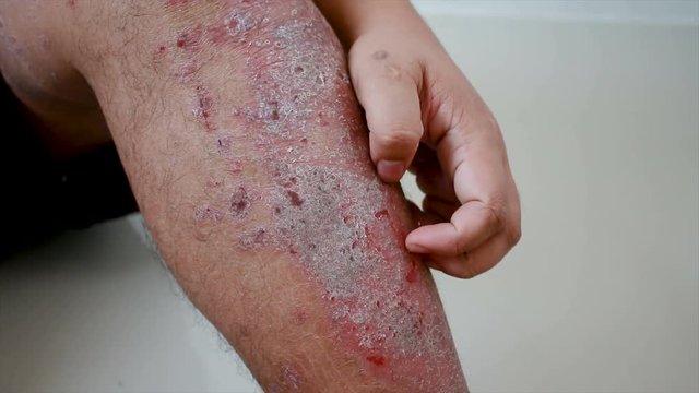 4K Close up shot hands of man scratching skin rash Dermatitis psoriasis patient itchy scratch wound