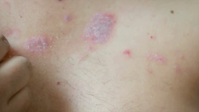 4K Close up shot hands of man scratching skin rash Dermatitis psoriasis patient itchy scratch wound