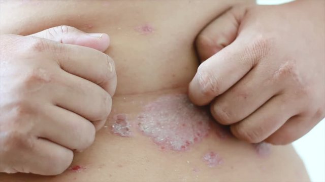 4K Close up shot hands of man scratching skin rash Dermatitis psoriasis patient itchy scratch wound
