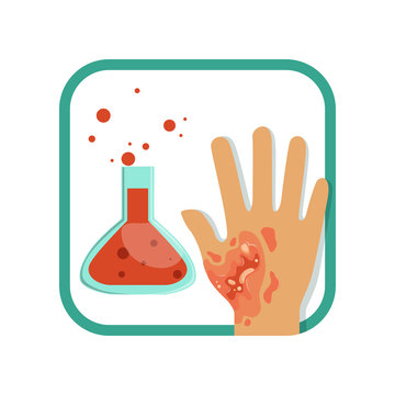 Chemical burn of third-degree. Hand with damaged outer (epidermis) and inner (dermis) layer of skin. Severe injury. Flat vector design for poster or brochure
