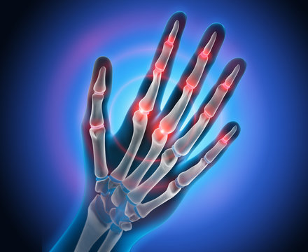  Arthritis in Fingergelenken 2