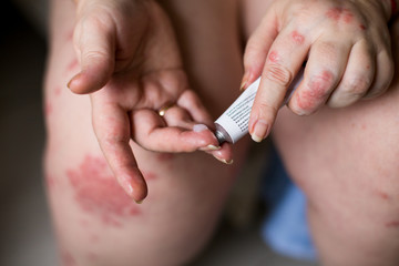 Skin Care Concept. Moisturizer Cream gel in tube on Dry Skin Hand. Applying an emollient to dry...
