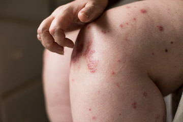 Fototapeta premium The problem with many people - eczema or psoriasis on hand skin. Woman itchind dry skin on legs. Ill allergic rash