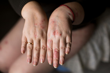 Close up of hand with very dry skin and deep cracks on knuckles. Healthcare concept. Psoriasis or...