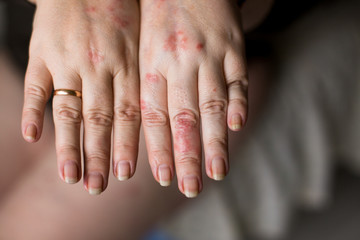 Close up of hand with very dry skin and deep cracks on knuckles. Healthcare concept. Psoriasis or eczema on hands