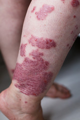 Fototapeta premium Allergic rash dermatitis eczema skin on leg of patient. Psoriasis and eczema skin with big red spots