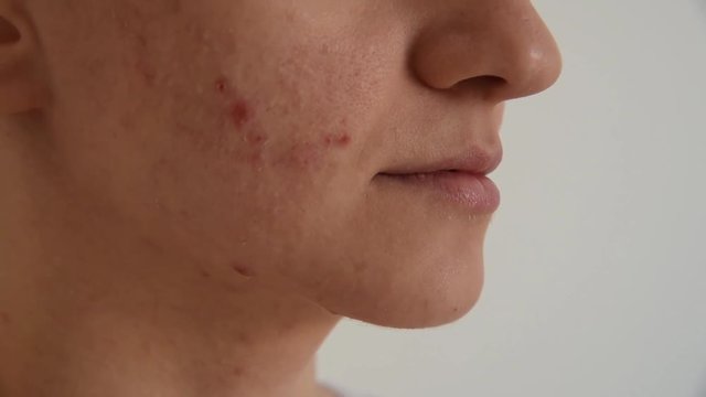 Beautiful young brunette girl crushes white and red pimples and acne on her face on a white background