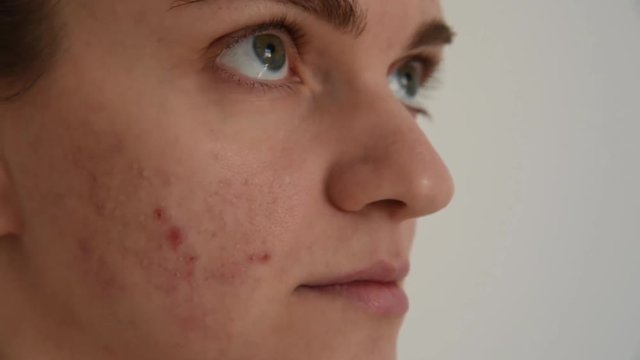 Beautiful young brunette girl crushes white and red pimples and acne on her face on a white background