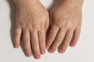 Scarlet fever. Two children's hands with rash on white background.