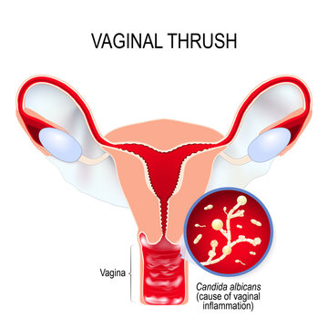 Vaginal Yeast Infection And Candida Albicans