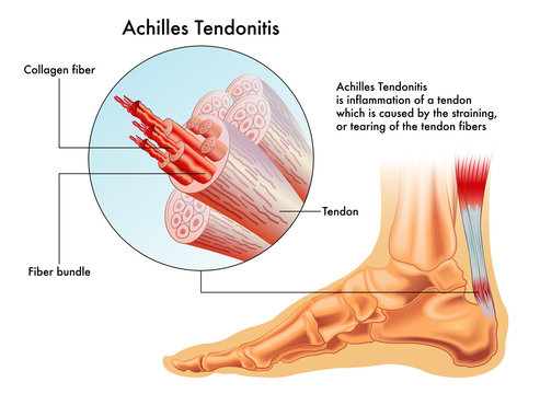 symptoms of  achilles tendonitis