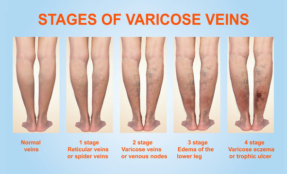 tratamentul varicosera reticular de unde va cumpara ciorapi elastici pentru varice