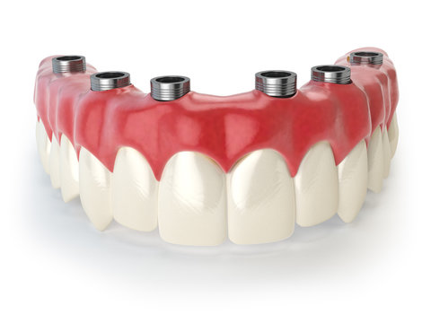 Dental prothesis isolated on white