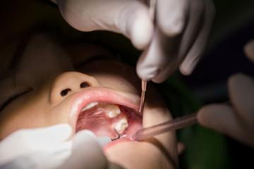 Dentist examines the teeth of children. Close up. Opened mouth and teeth.