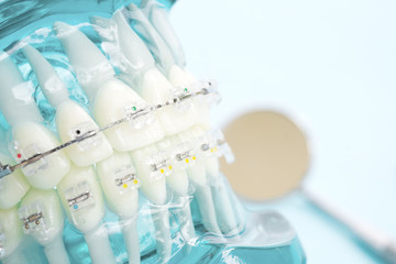 orthodontic model and dentist tool - demonstration teeth model of varities of orthodontic bracket or brace