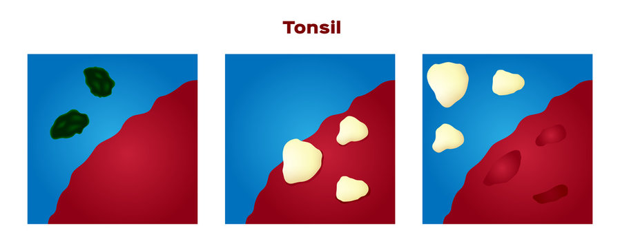 tonsil stone in the mouth vector