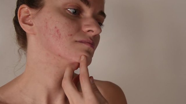 Beautiful young brunette girl crushes white and red pimples and acne on her face on a white background