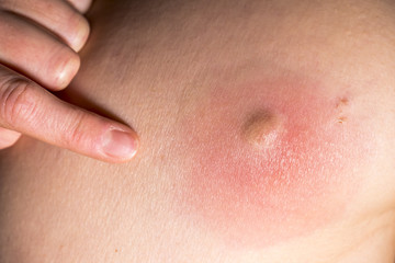 Closeup of an huge abcess getting inflamed