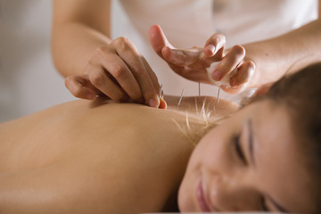 The doctor sticks needles into the woman's body on the acupuncture - close up - obrazy, fototapety, plakaty