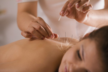The doctor sticks needles into the girl's body on the acupuncture - close up - obrazy, fototapety, plakaty