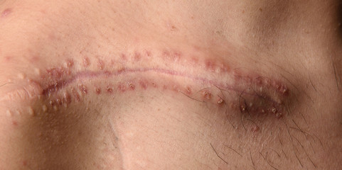 Fototapeta premium detail of a scar on the clavicle