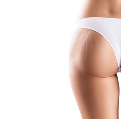 Female buttocks with stretching marks.