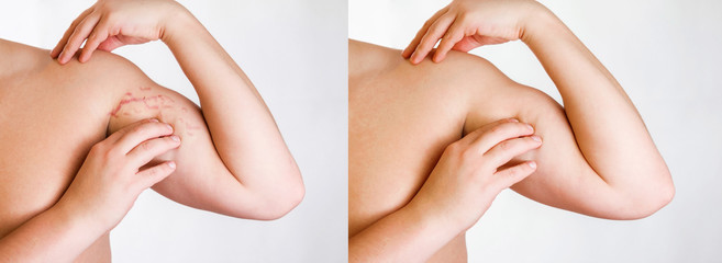 body striae, stria on the arm  before and after surgery and procedure - obrazy, fototapety, plakaty